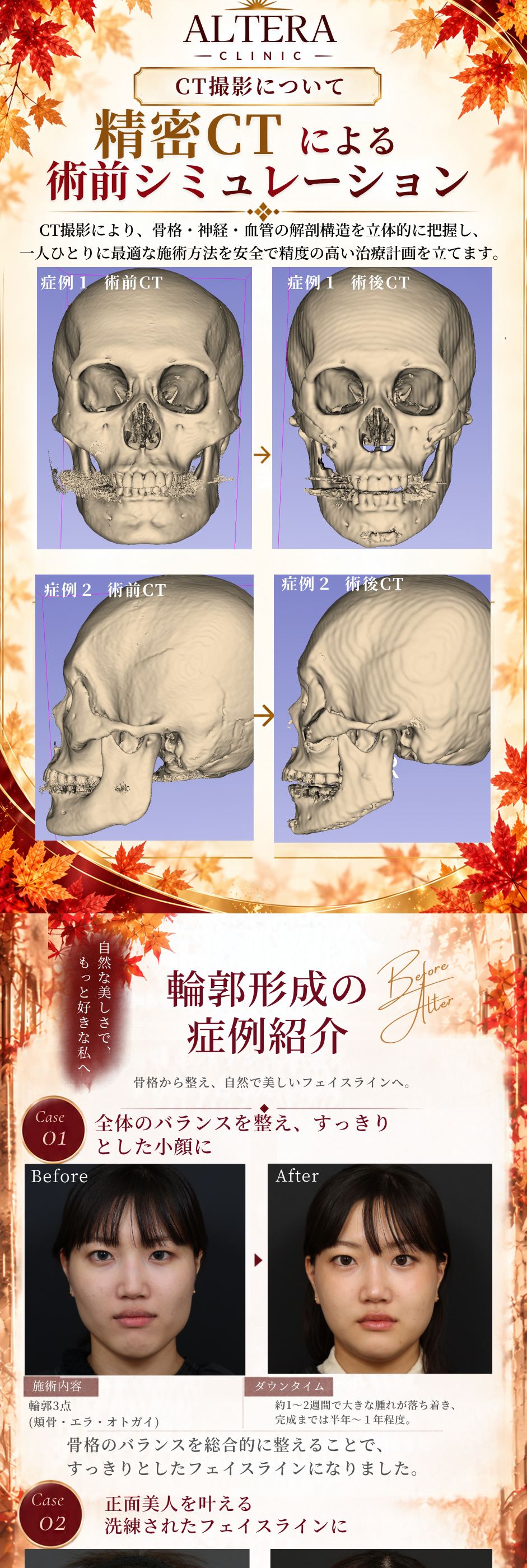 選ばれる理由（術後フォローが充実・麻酔管理まで徹底）｜精密CTによる術前シミュレーション（症例1・症例2の術前CT・術後CT）｜輪郭形成の症例紹介 Case01・Case02（術前・術後）