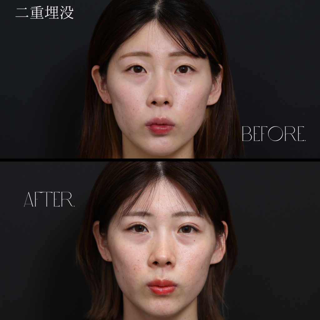 二重埋没・目元整形の症例写真