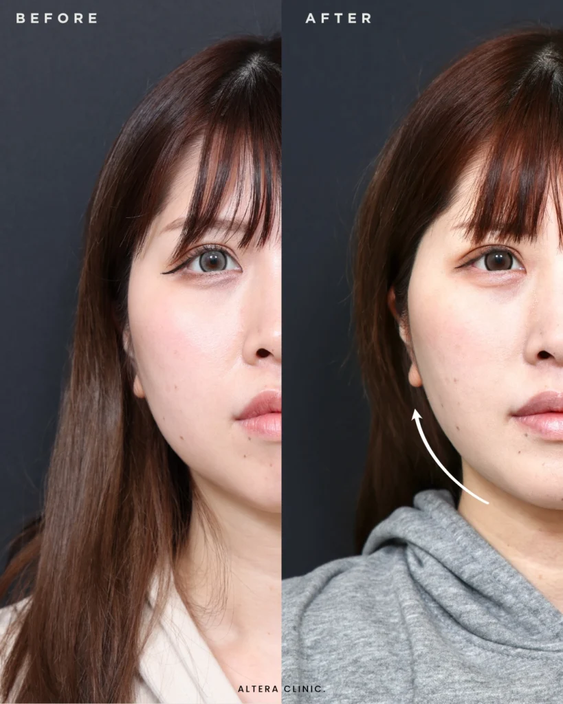 脂肪吸引・脂肪吸引・脂肪除去の症例写真