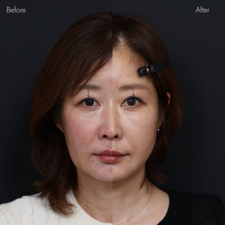 眉下切開・目元整形の症例写真