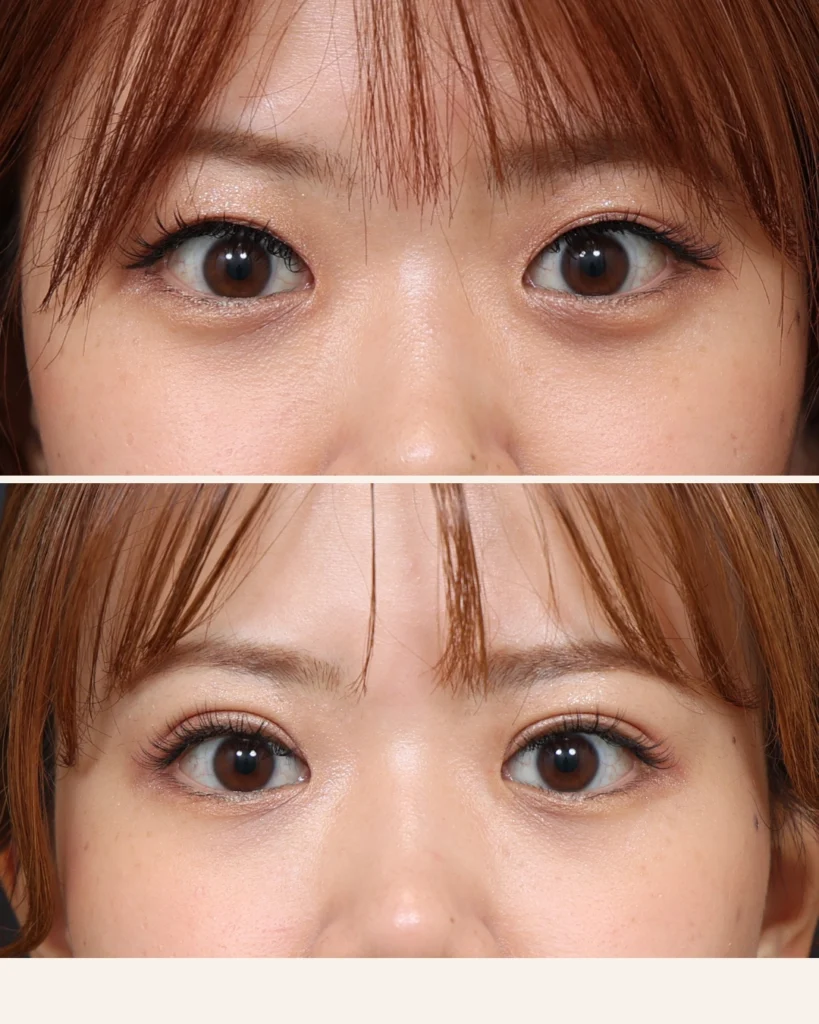 二重埋没・目元整形の症例写真