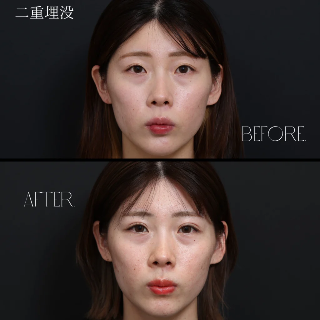 二重埋没・目元整形の症例写真