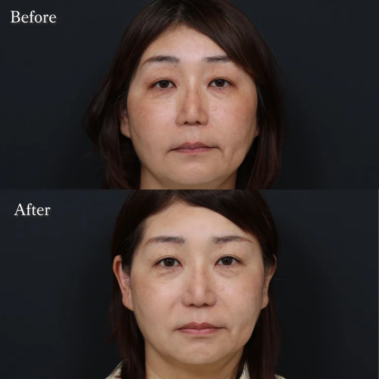 眉毛下切開・目元整形の症例写真