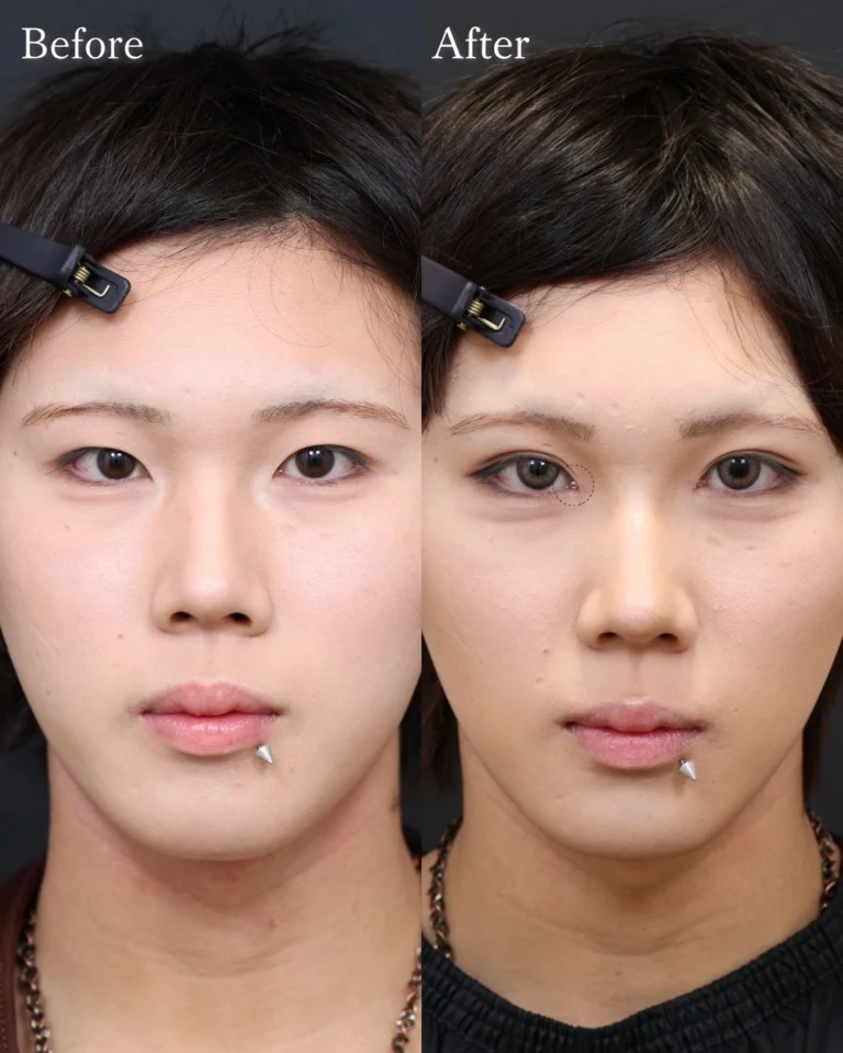 二重埋没・目頭切開・目元整形の症例写真