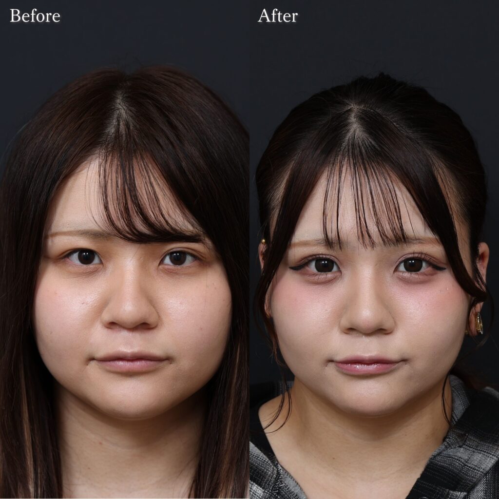 ヒアルロン酸注入・注入系の症例写真