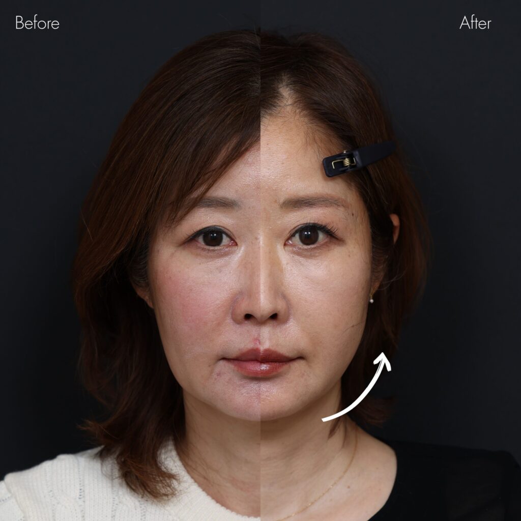 糸リフト・リフト・たるみ治療の症例写真