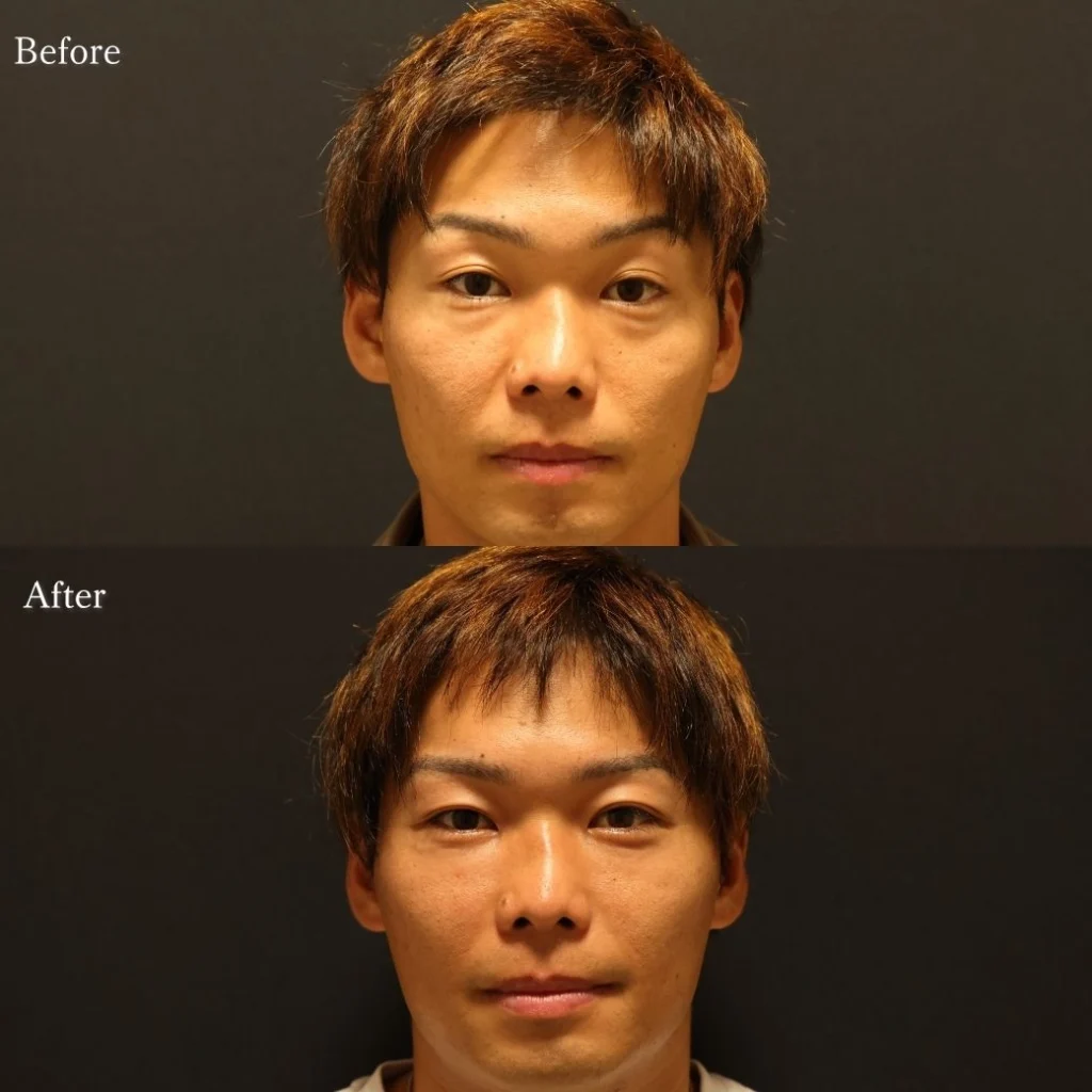 裏ハムラ・目元整形の症例写真
