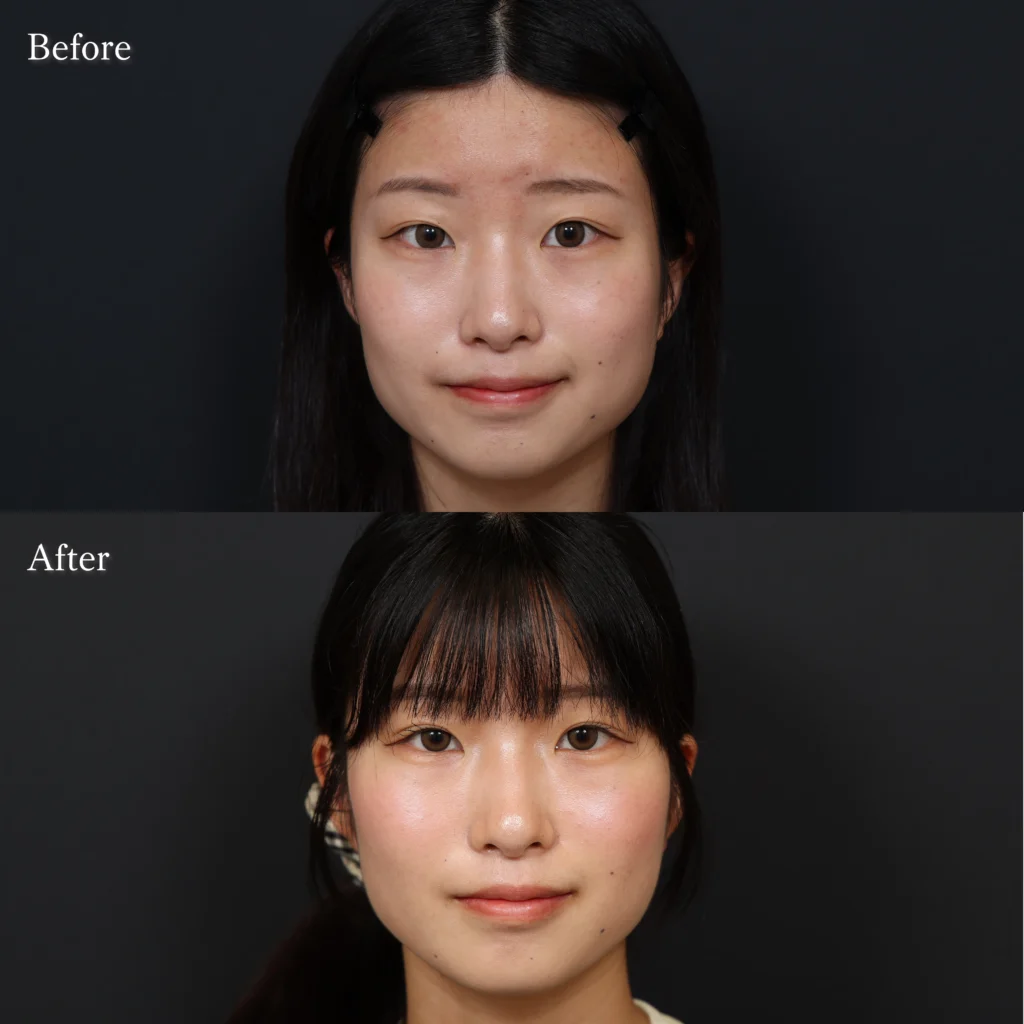 二重埋没・目元整形の症例写真