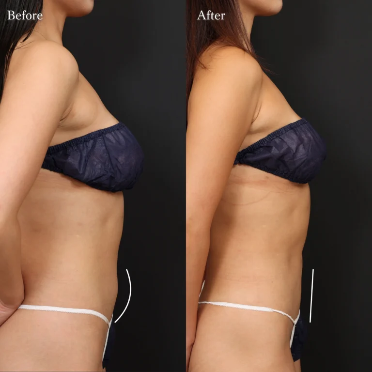 脂肪吸引・脂肪吸引・脂肪除去の症例写真