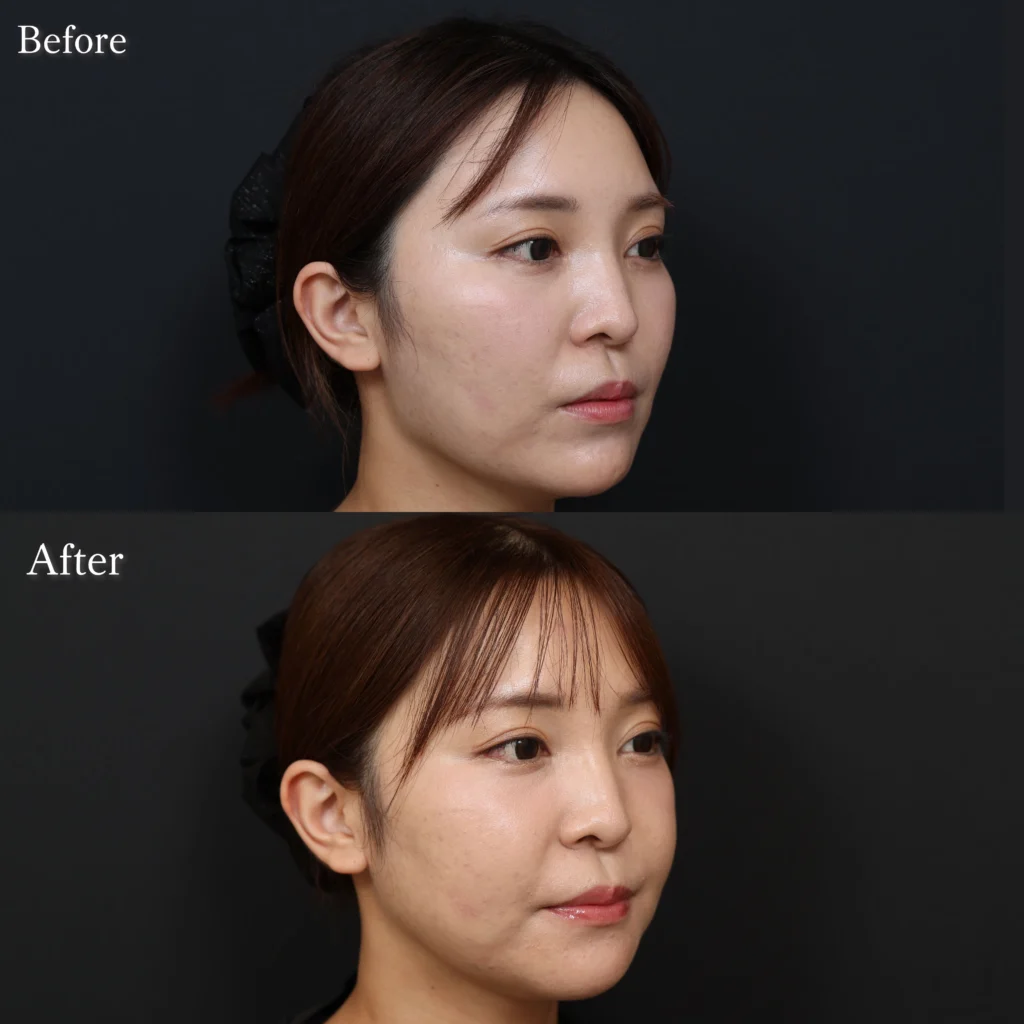 頬骨骨切り、エラ形成・骨切りの症例写真