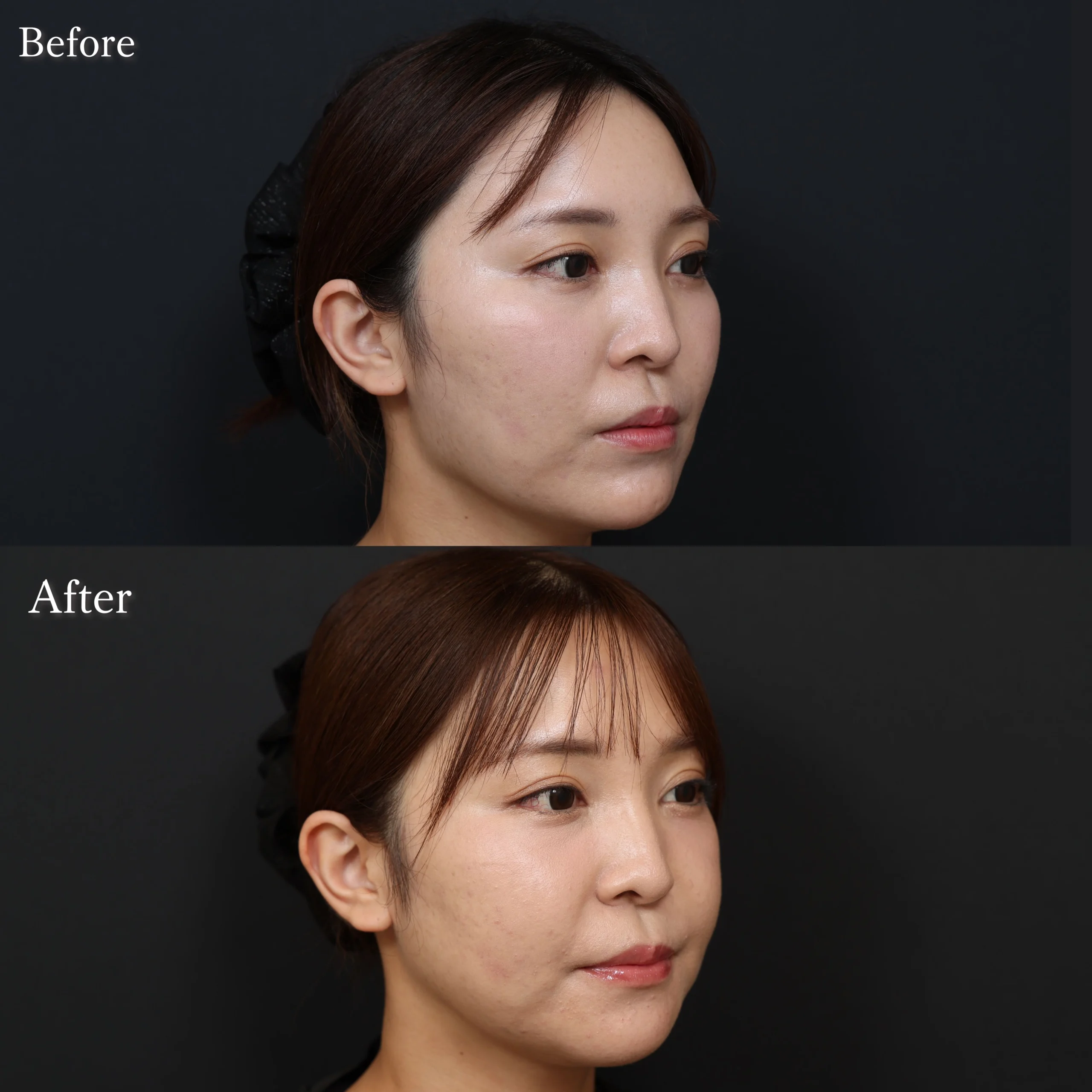 頬骨骨切り、エラ形成・骨切りの症例写真