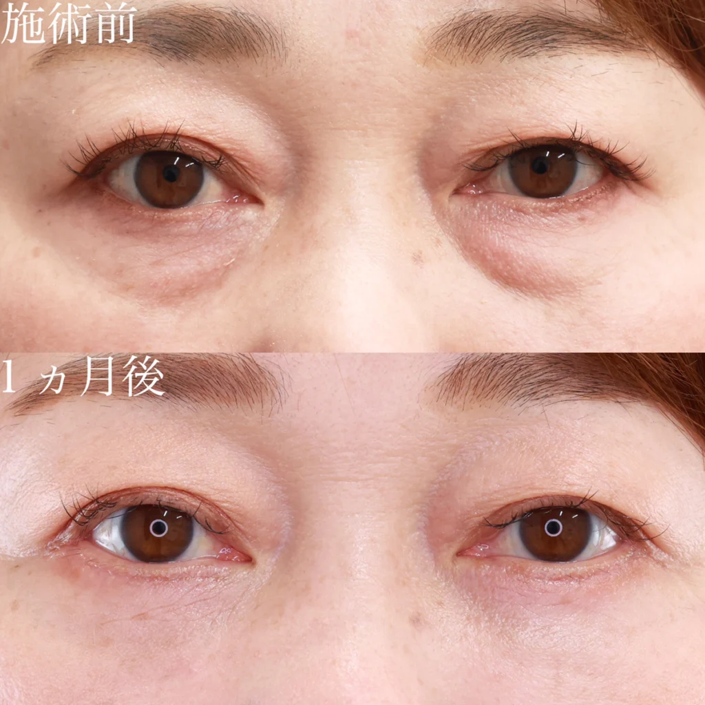 クマ取り（脱脂）＋下眼瞼皮膚切除術・目元整形・術後1か月の症例写真