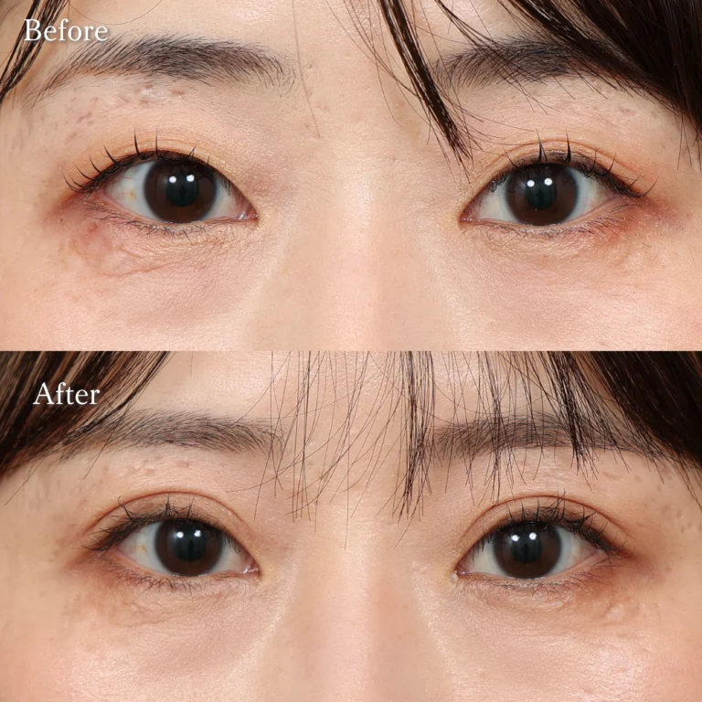 二重埋没・目元整形の症例写真
