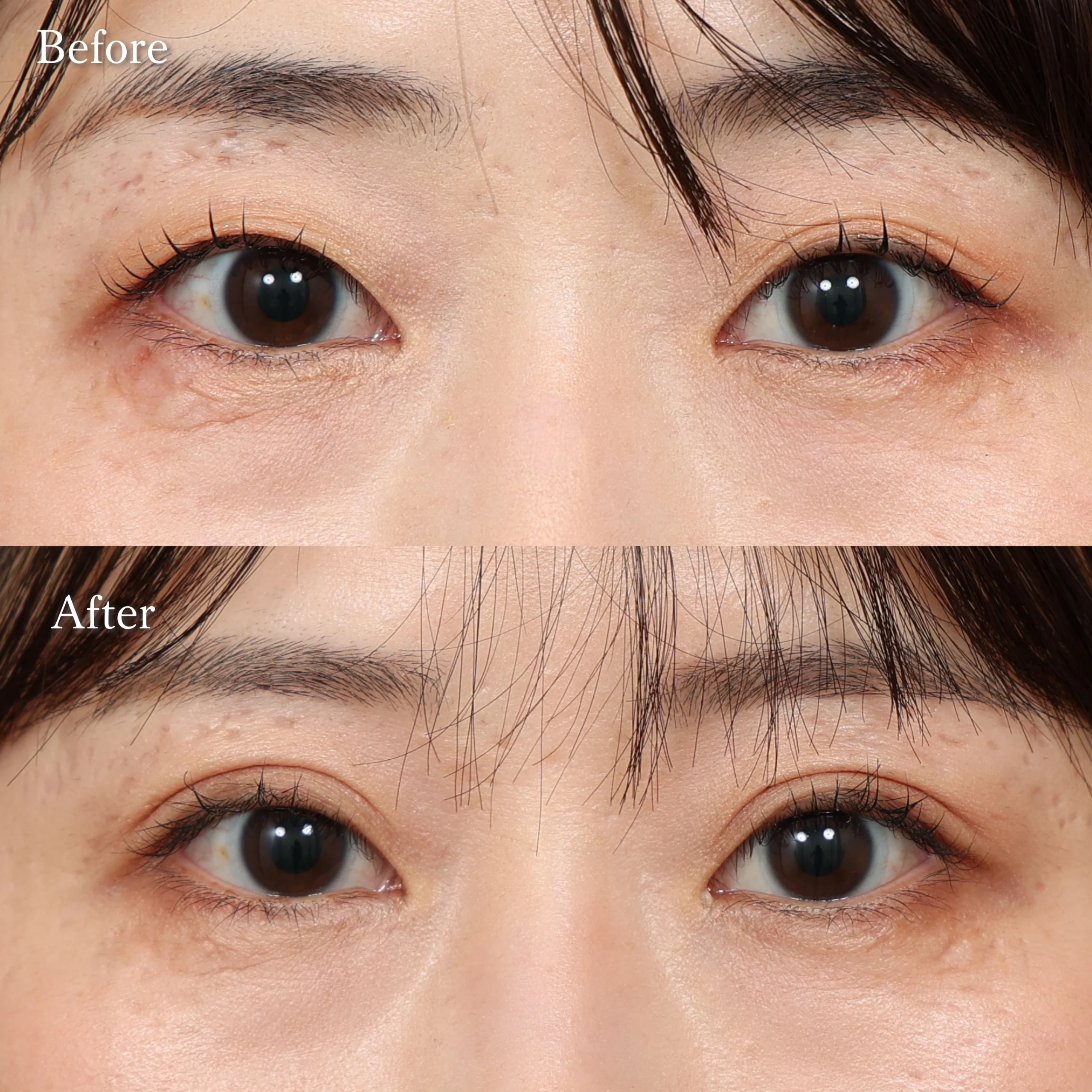 二重埋没・目元整形の症例写真