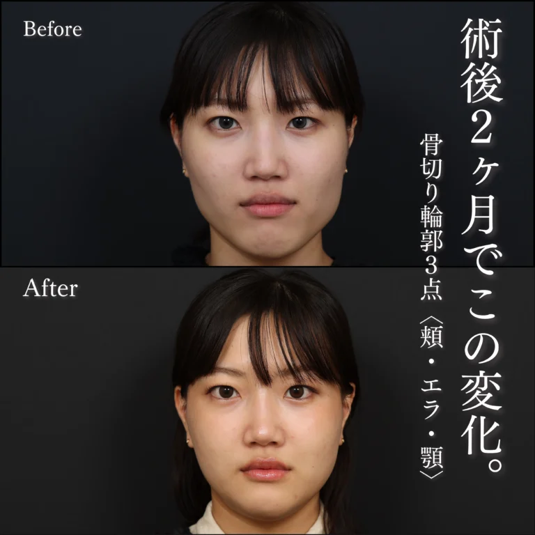骨切り輪郭３点・骨切り・術後2ヶ月の症例写真