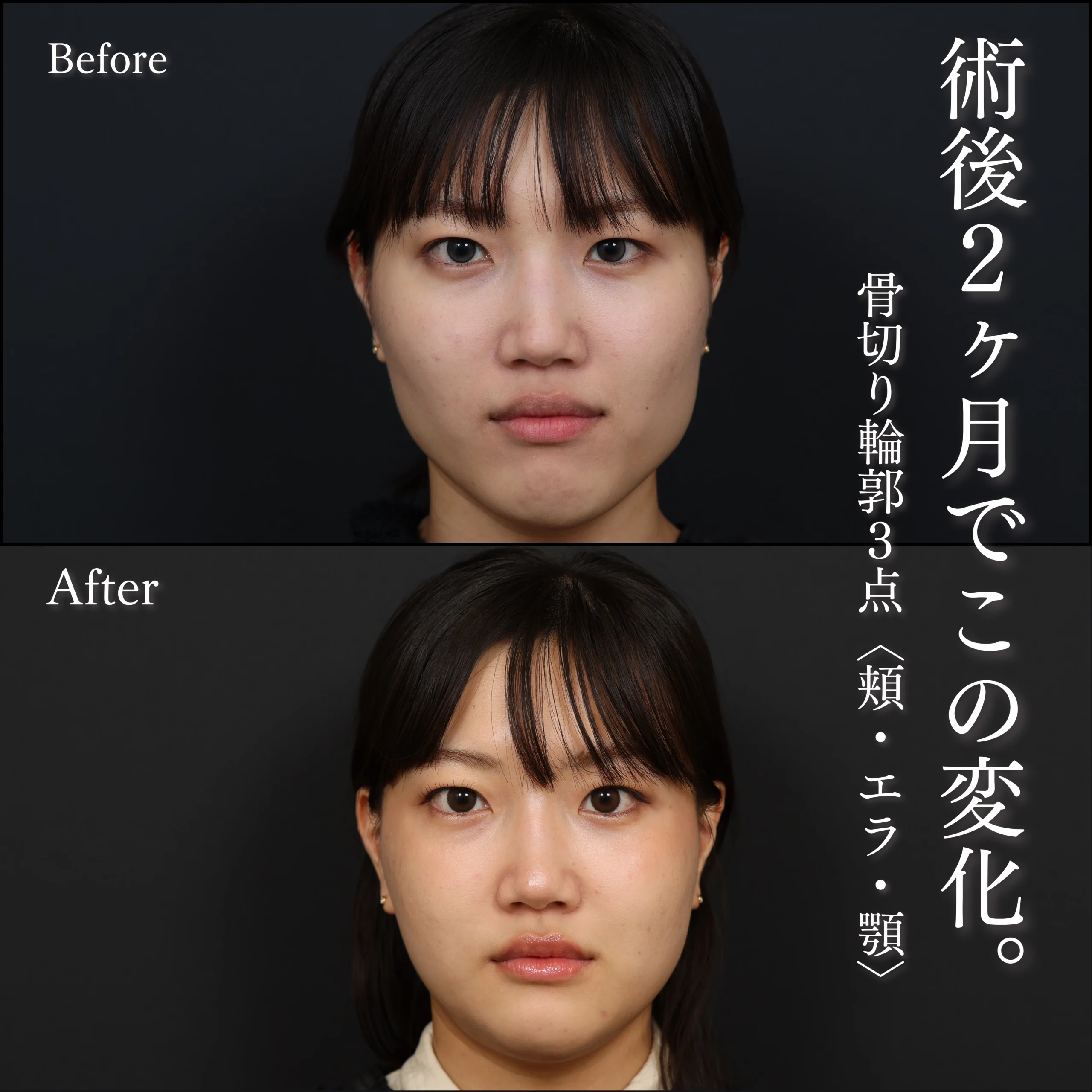 骨切り輪郭３点・骨切り・術後2ヶ月の症例写真
