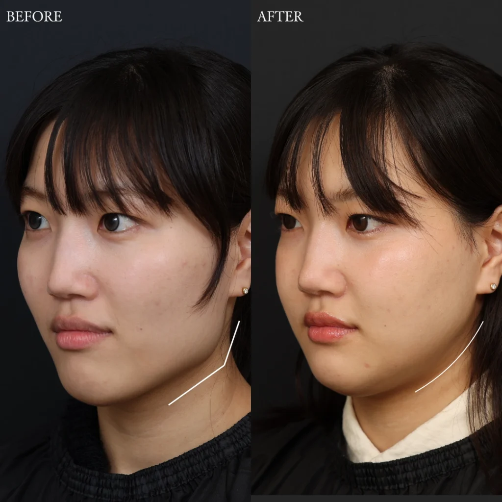 Altera Clinicの骨切り(輪郭形成)3点のBefore/After症例写真。頬骨・エラ・顎先の骨格バランスを整え、フェイスラインの変化を比較。