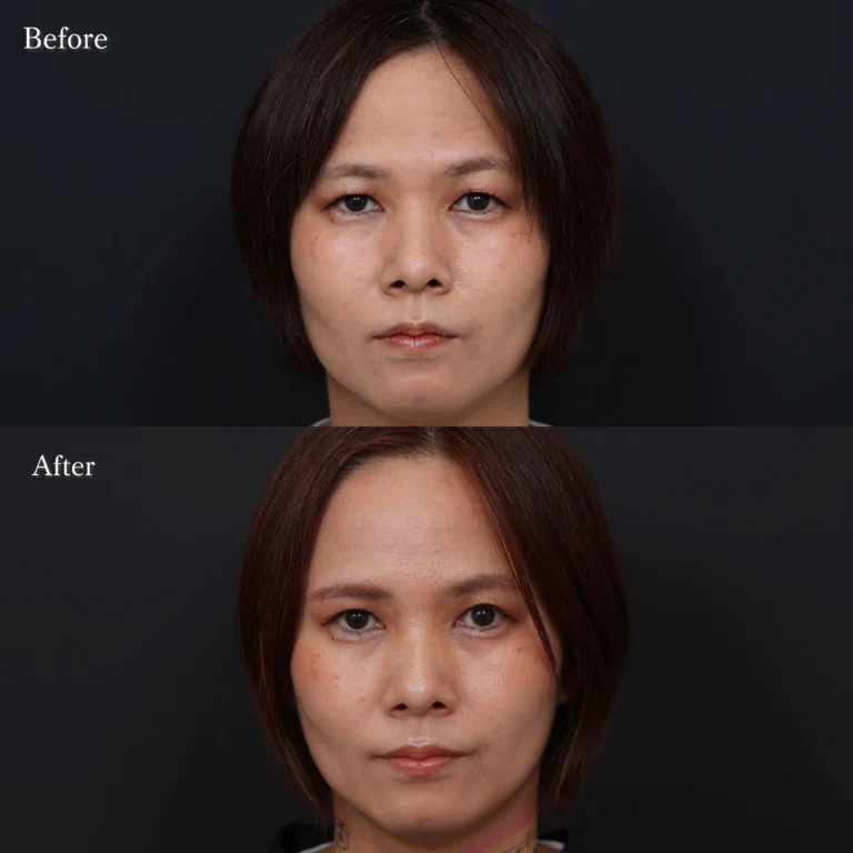 眉下切開・目元整形の症例写真