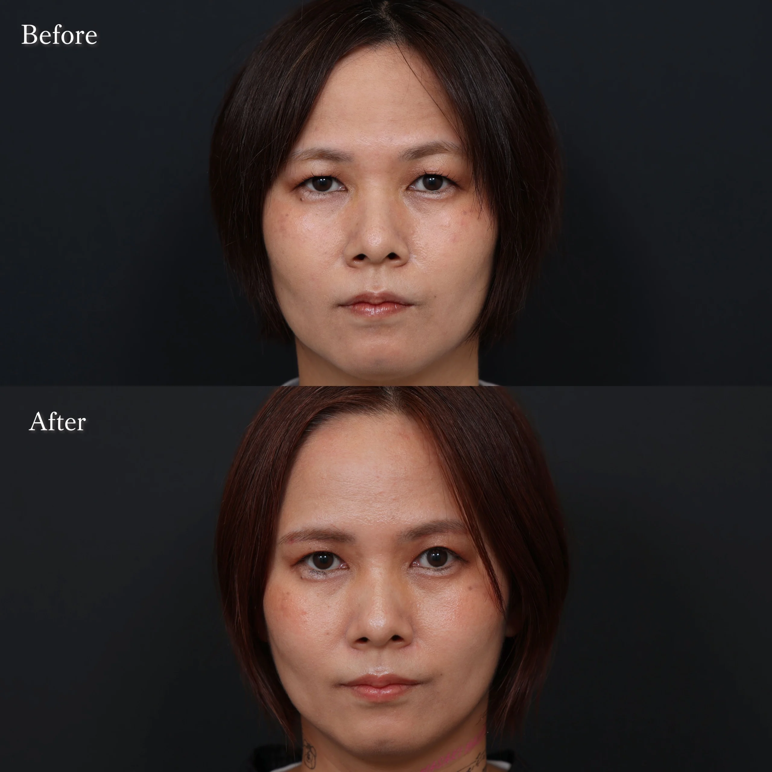眉下切開・目元整形の症例写真