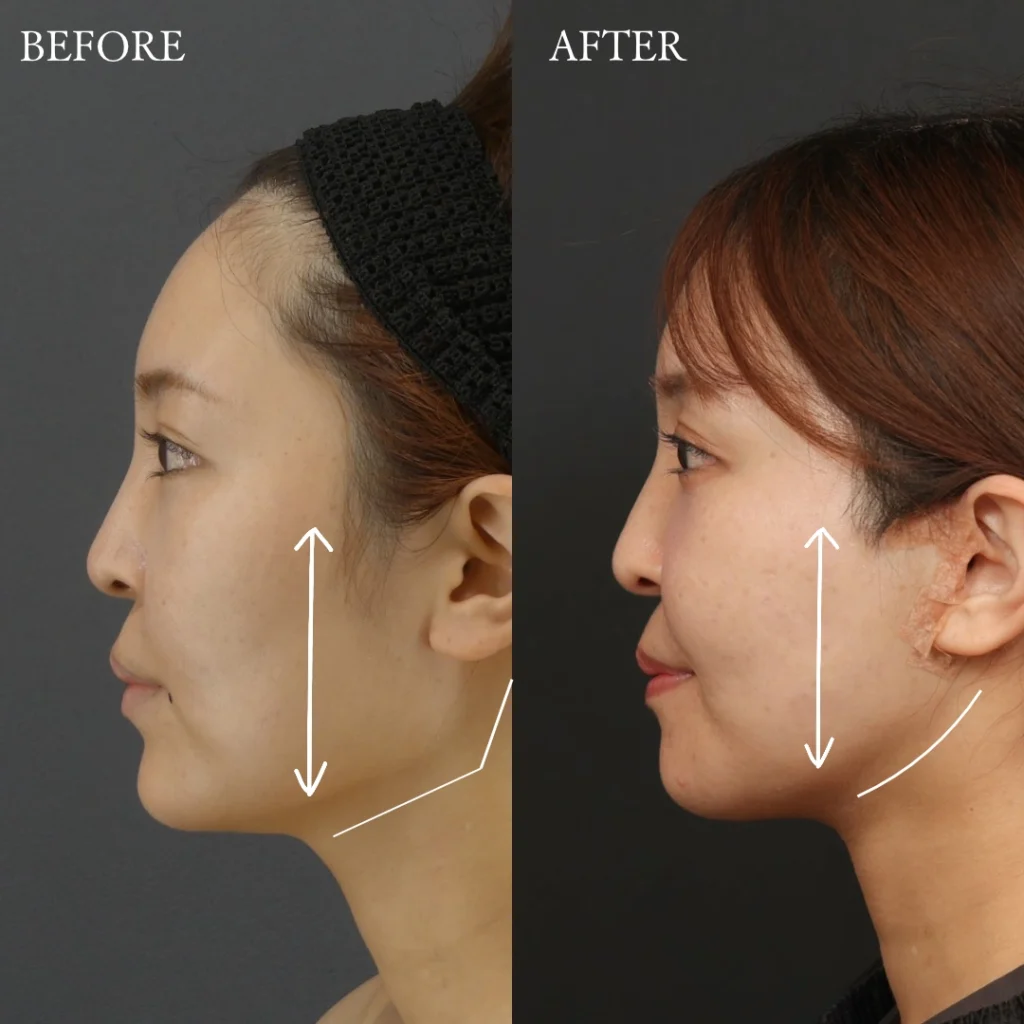 Altera Clinic（アルテラクリニック）の骨切り（輪郭形成）3点の横顔Before／After症例写真。頬骨・エラ・顎先の骨切りによるフェイスラインや横顔の輪郭の変化を比較。