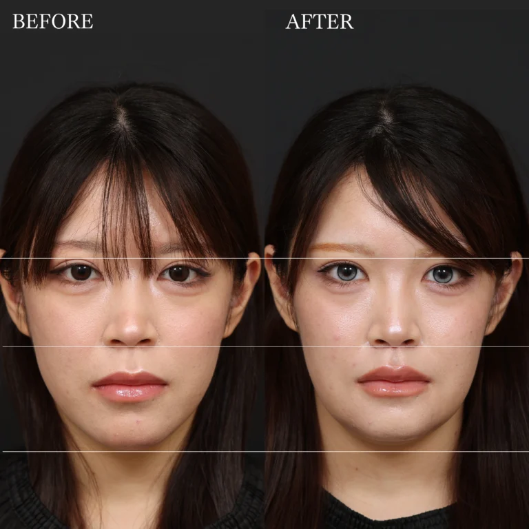 オトガイ形成・人中短縮・口元・骨切りの症例写真