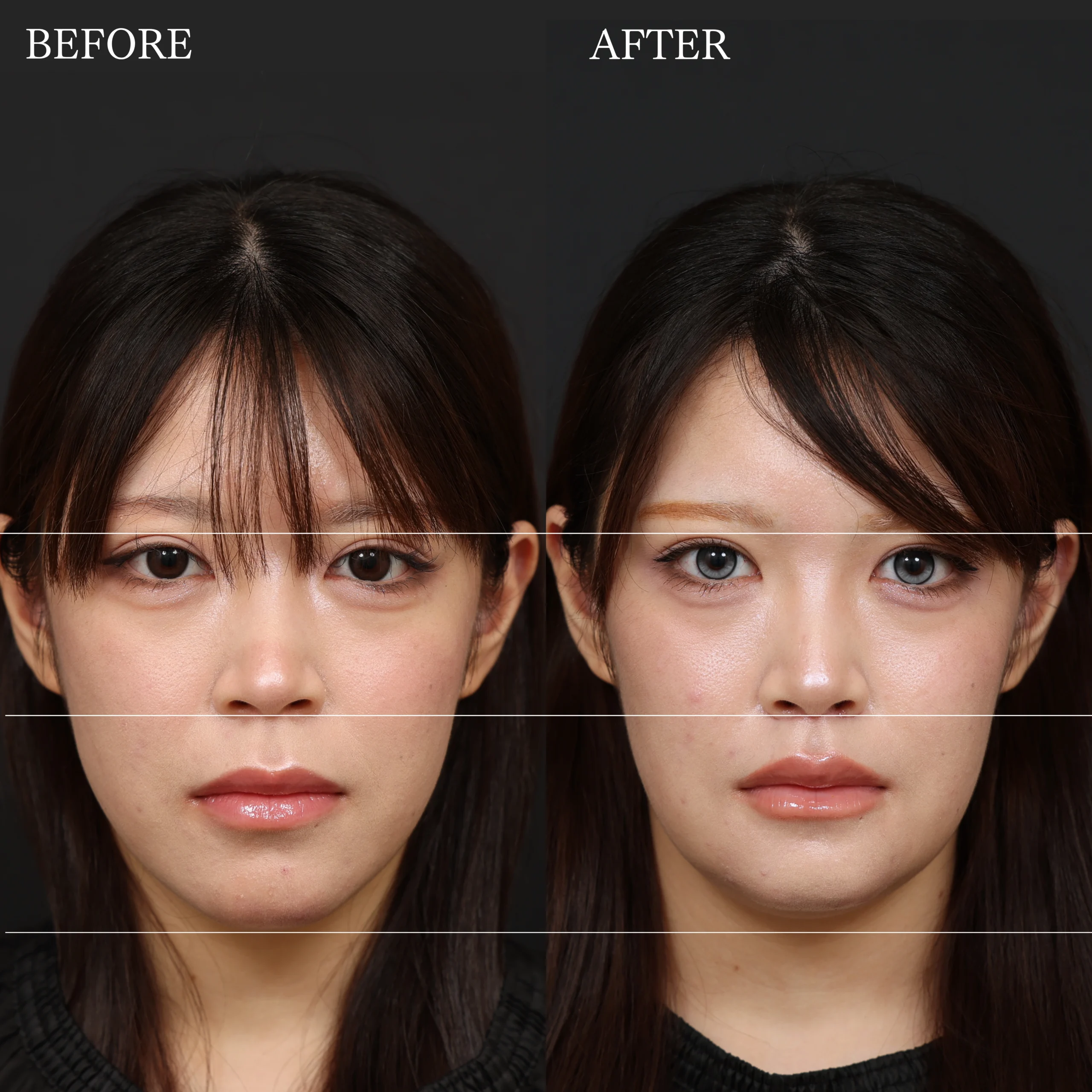 オトガイ形成・人中短縮・口元・骨切りの症例写真