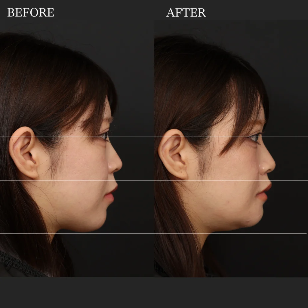 福岡のALTERA CLINICによる顎形成（オトガイ骨切り術）の横顔症例写真。術前・術後の顎先の位置や突出度、横顔のフェイスラインを比較した美容整形症例。