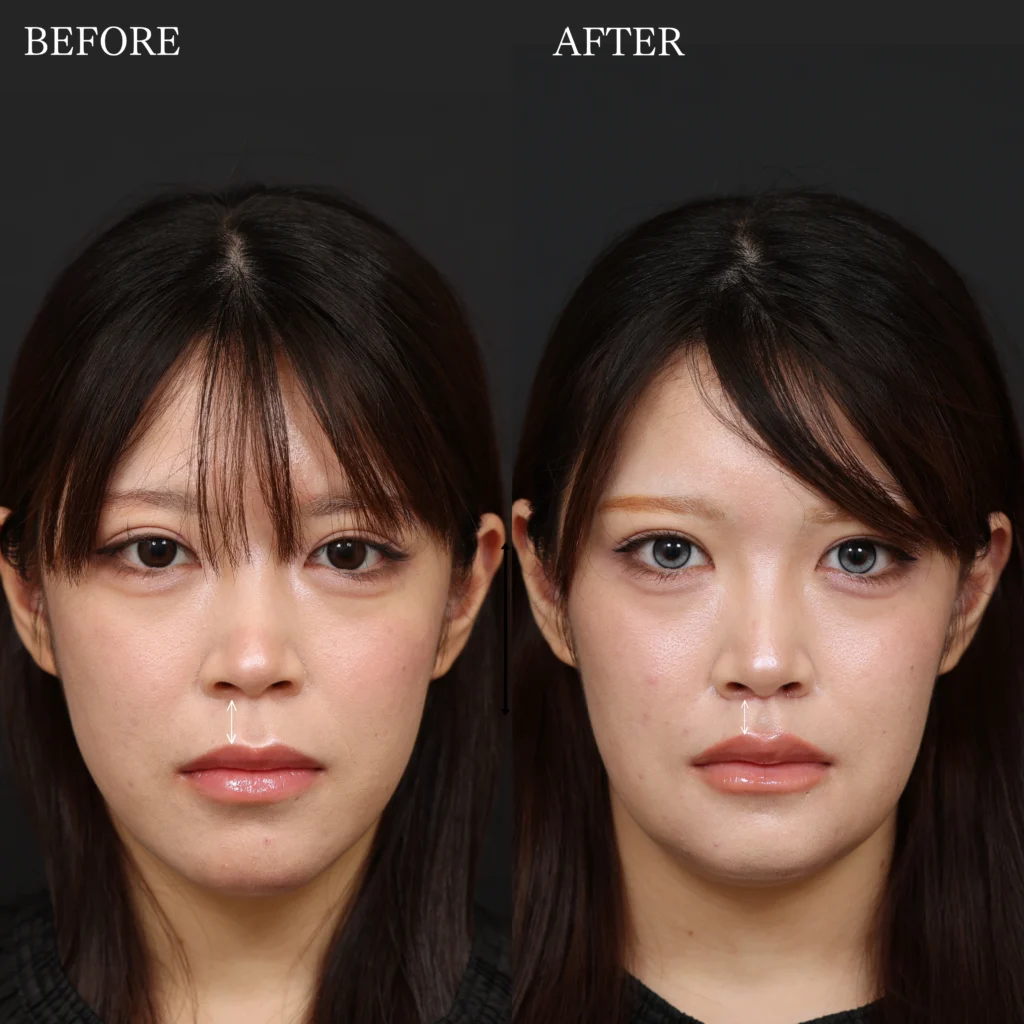 福岡のALTERA CLINICによる人中短縮（リップリフト）の術前・術後症例写真。鼻の下から上唇までの距離や口元のバランスを比較した美容整形症例。