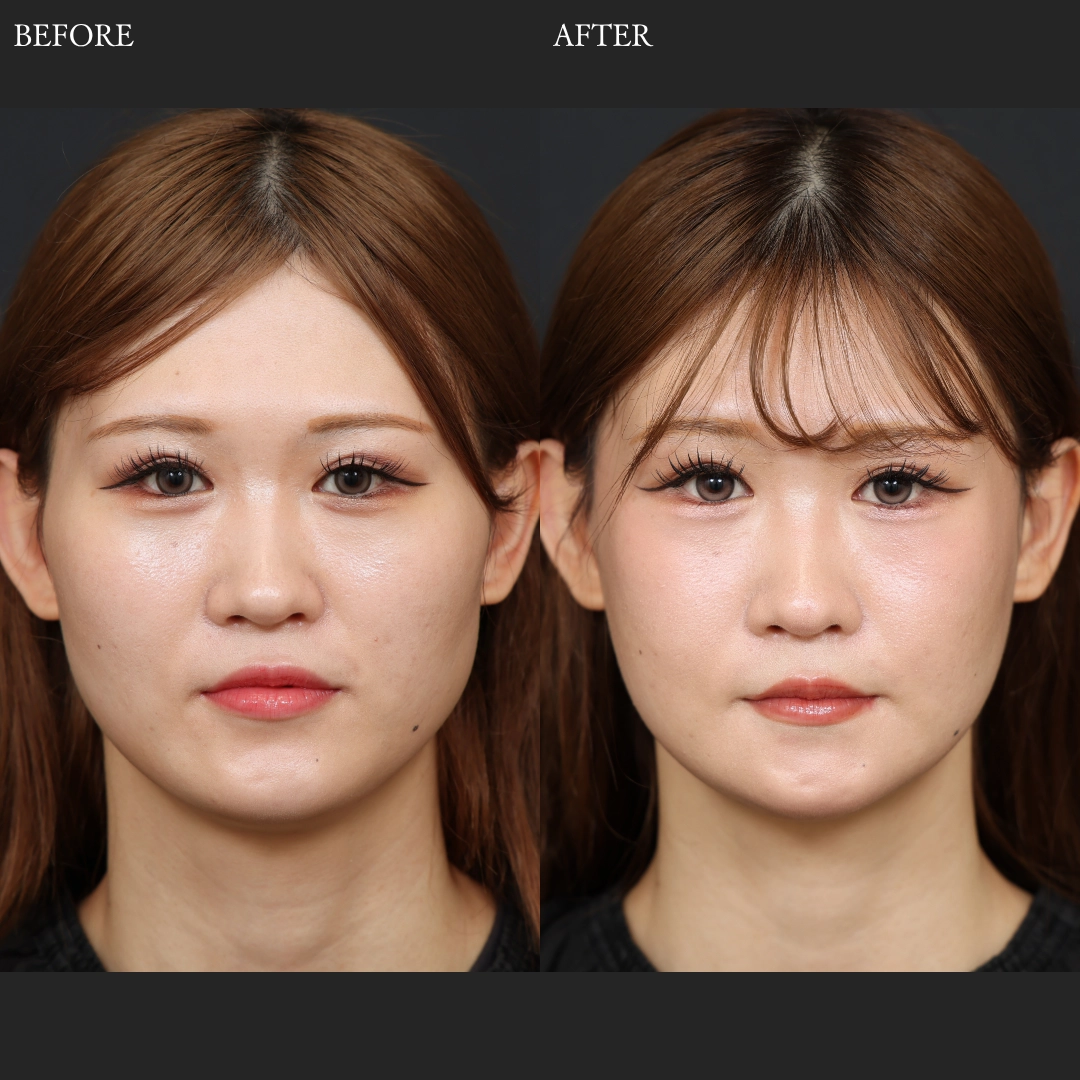 骨切り輪郭３点・骨切りの症例写真