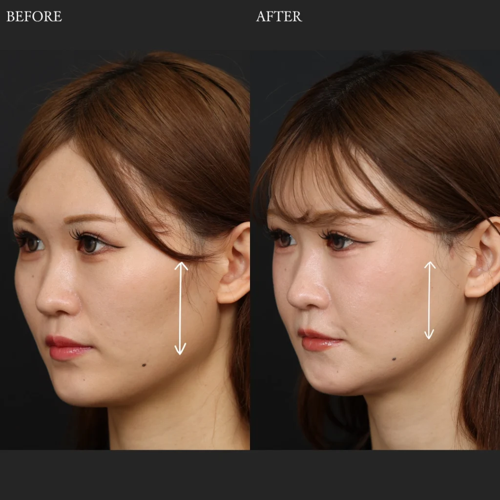 福岡Altera Clinicの骨切り（輪郭3点形成）左側面Before After症例写真。頬骨・下顎角・顎先の骨格と横顔の輪郭ラインの変化を比較。