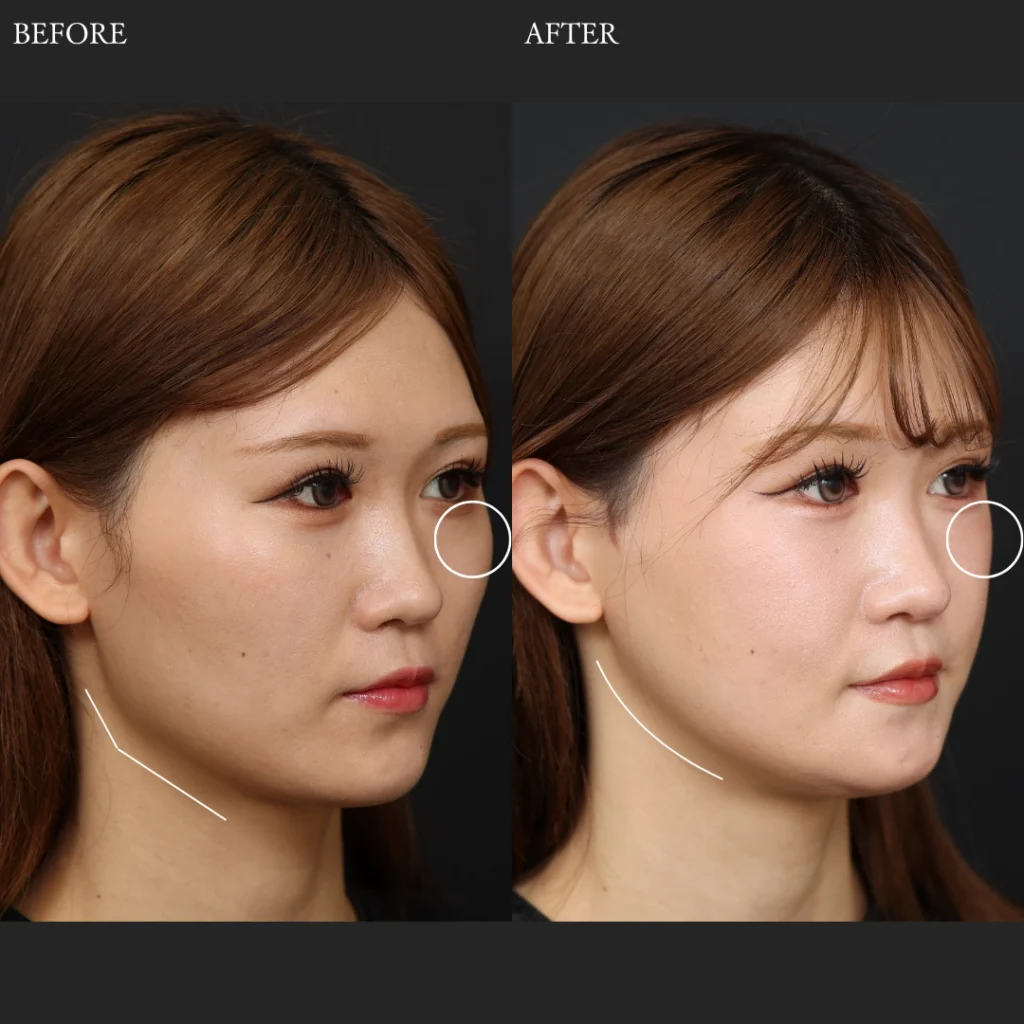 Altera Clinicの骨切り（輪郭3点形成）右側面Before After症例写真。頬骨・エラ・顎の骨格バランスと横顔のフェイスラインを比較。