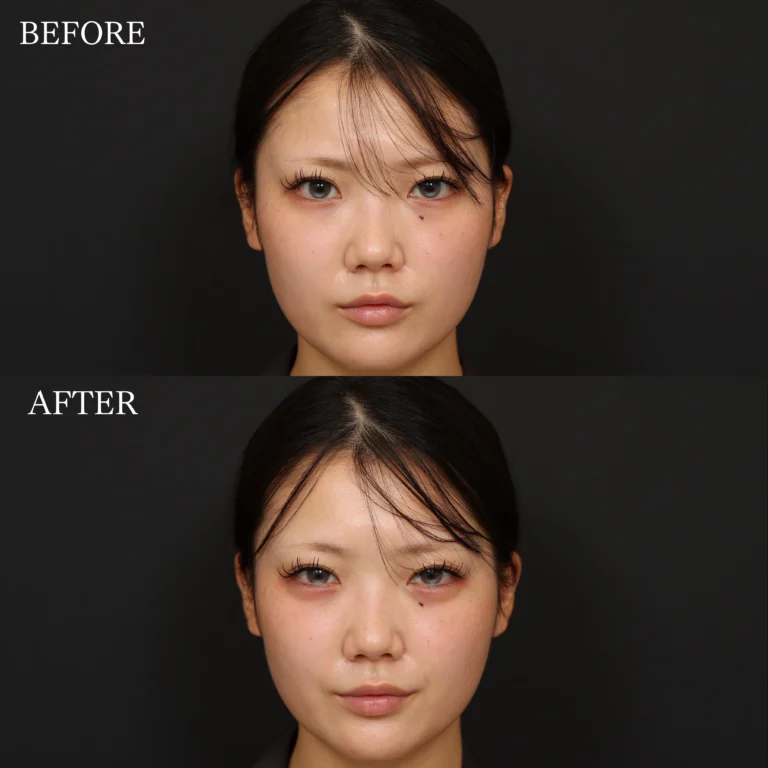 涙袋ヒアルロン酸注入・注入系の症例写真
