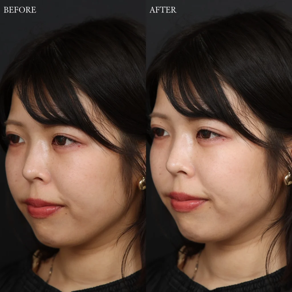 涙袋ヒアルロン酸・注入系の症例写真